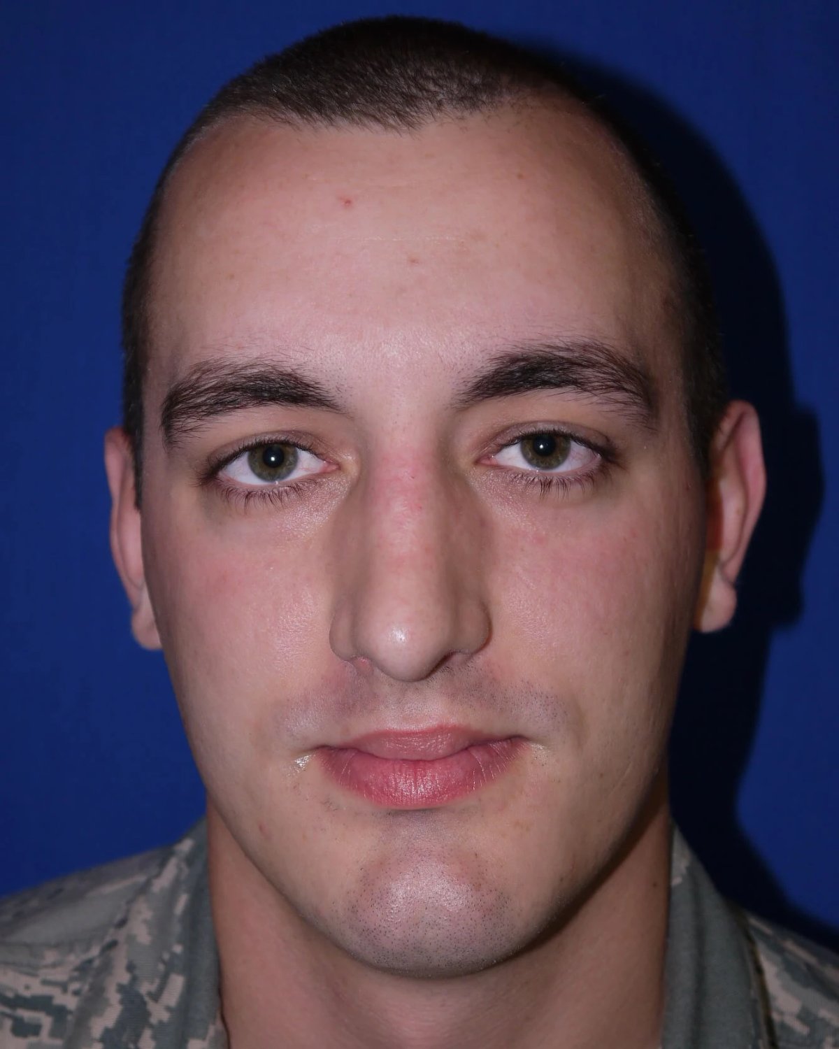 Rhinoplasty after