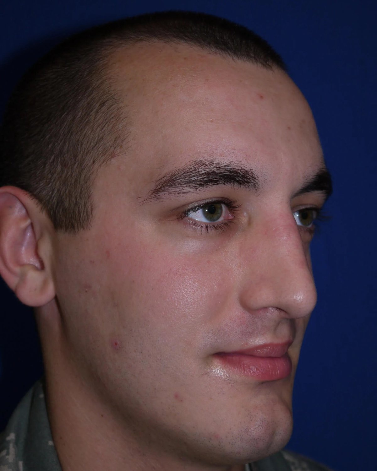 Rhinoplasty — Oblique Right view, after