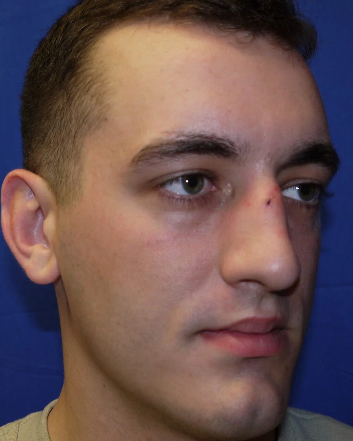 Rhinoplasty — Oblique Right view, before