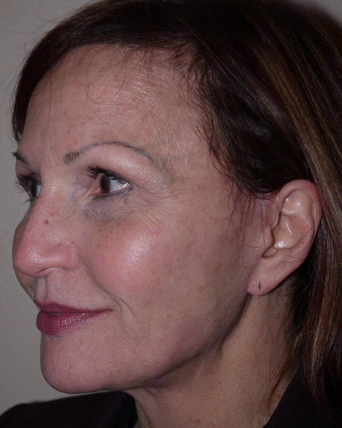 Facelift (neck lift included) — Oblique Left view, after