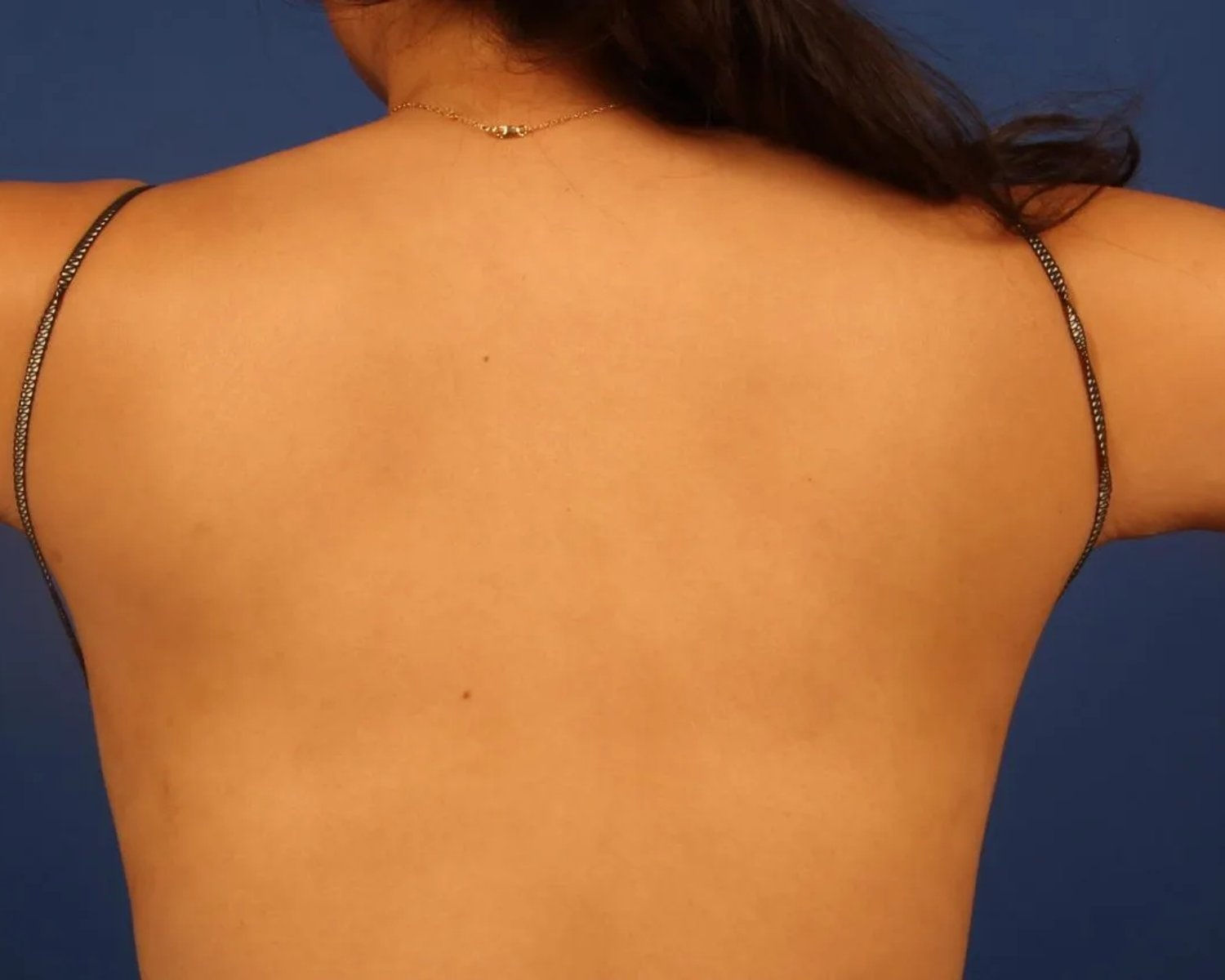 Arm Lift — Back view, after