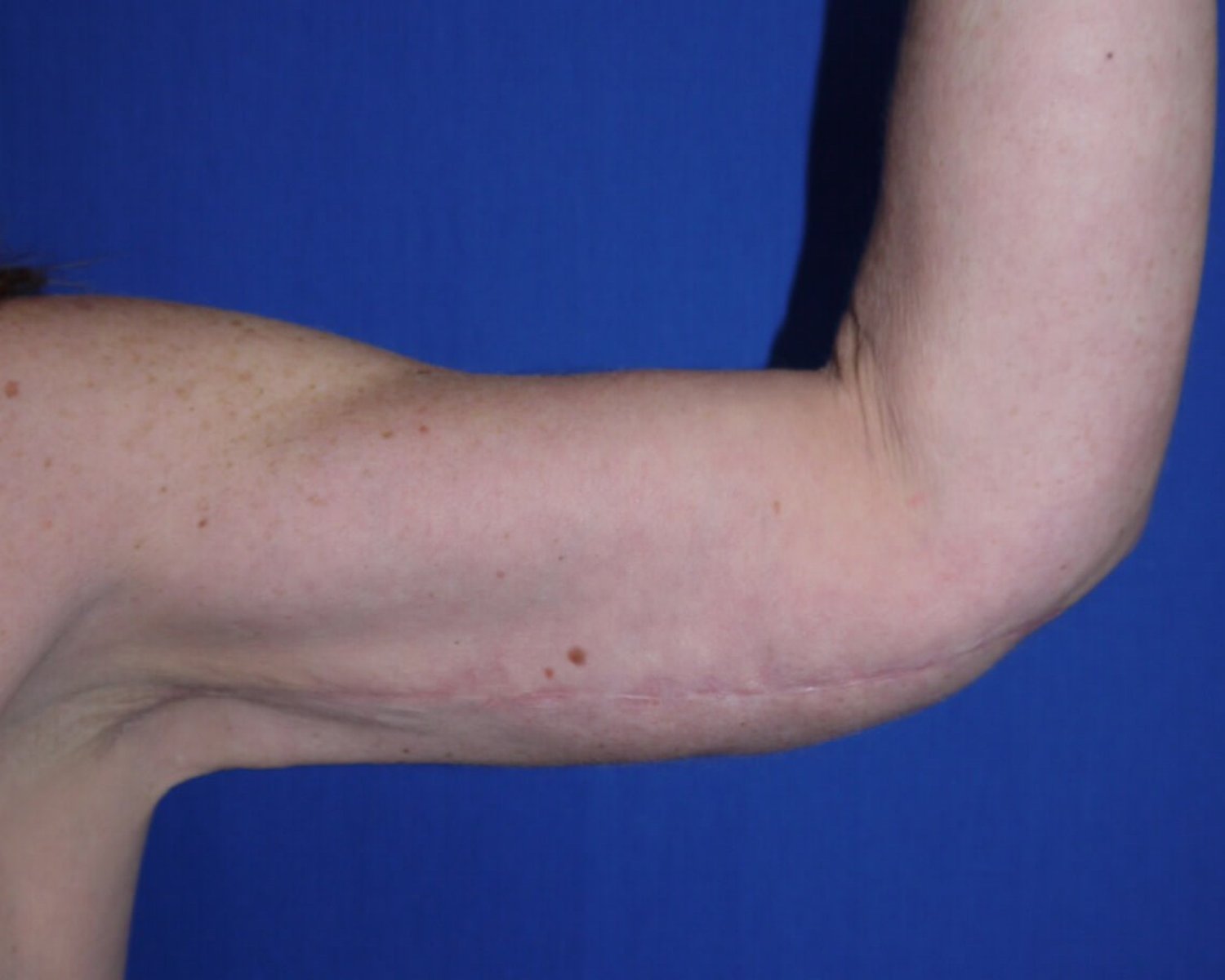Arm Lift — Oblique Left view, after