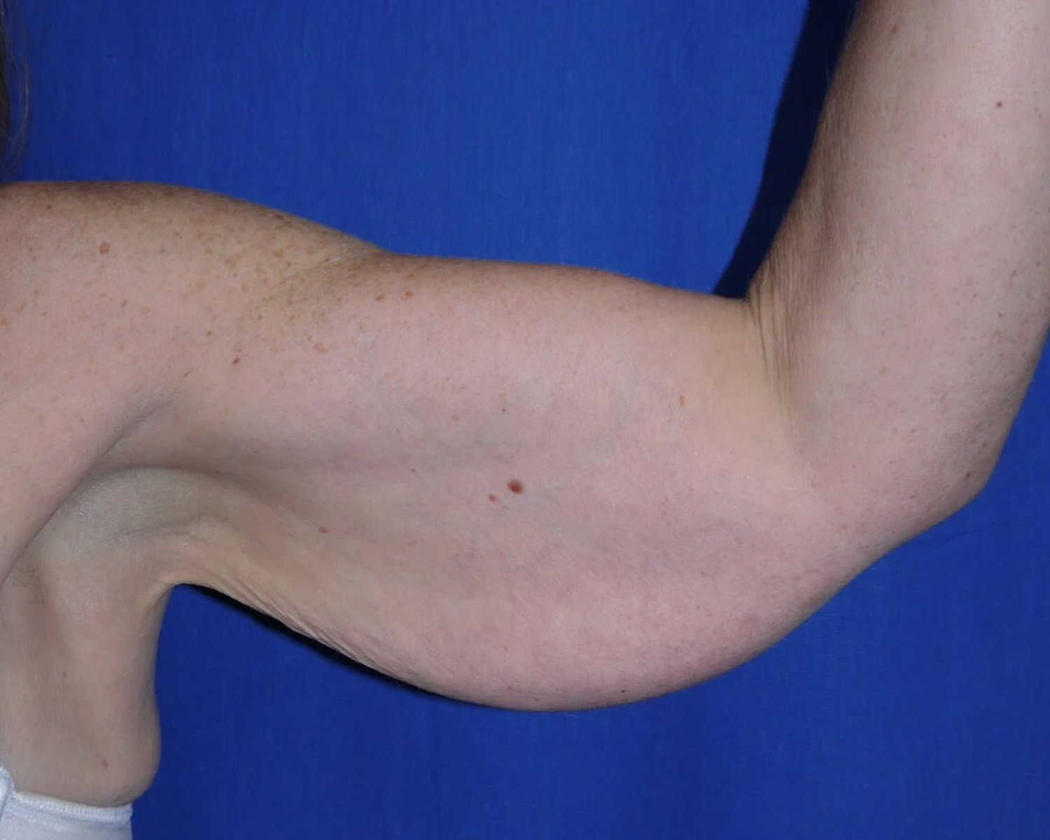 Arm Lift — Oblique Left view, before