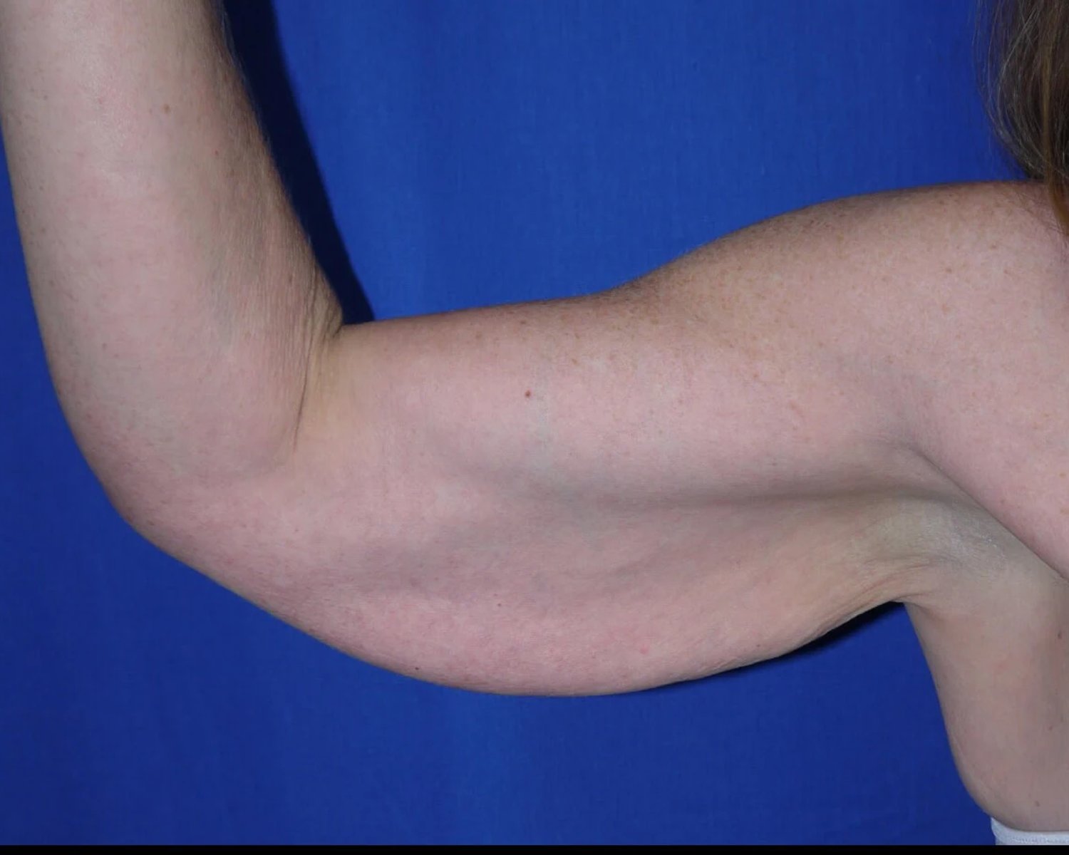 Arm Lift — Oblique Right view, before