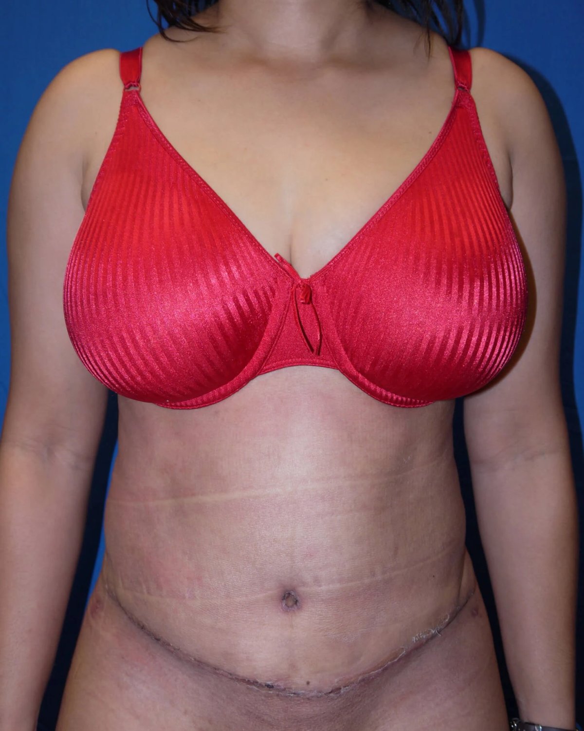 Tummy Tuck after