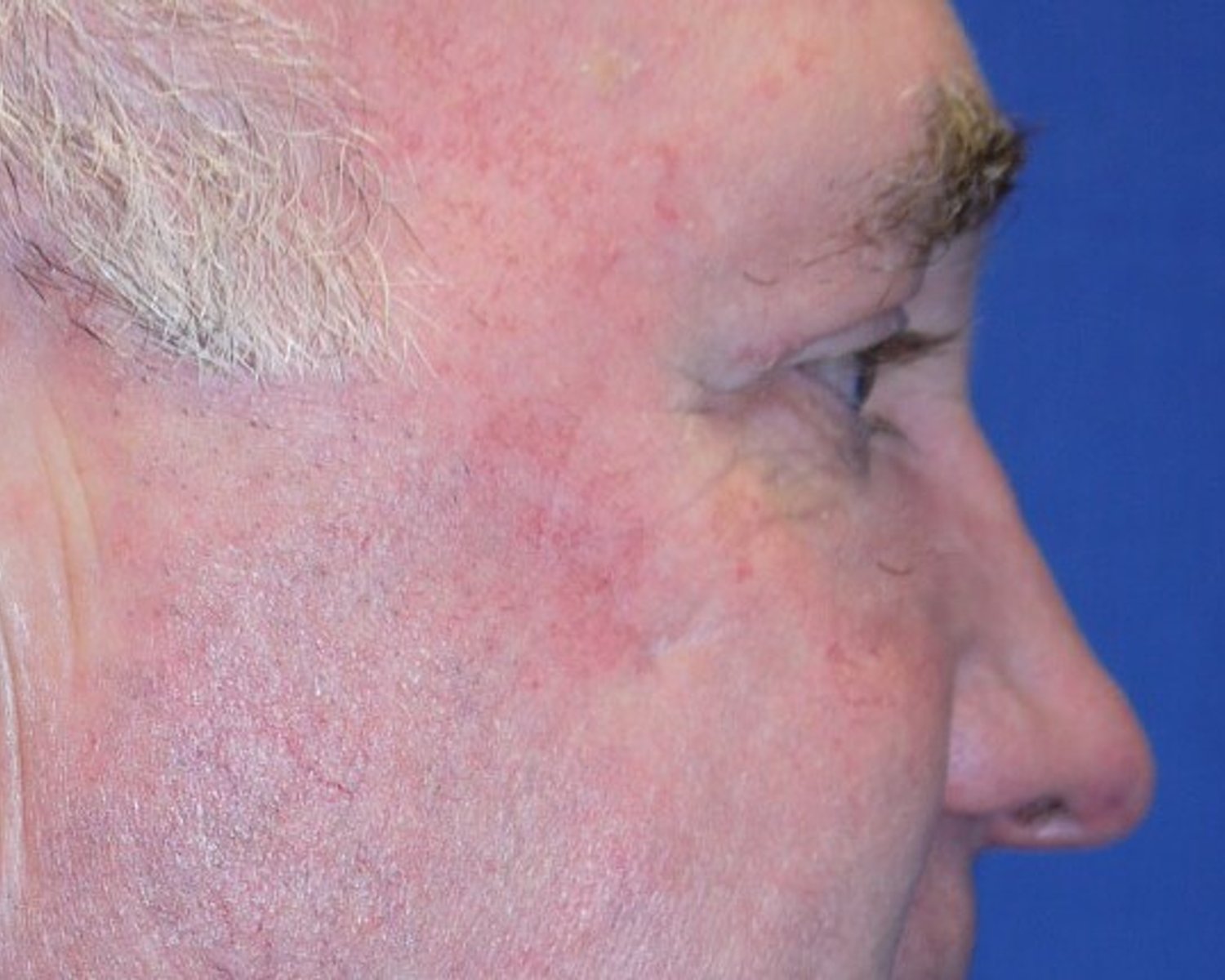 Eyelid Surgery — Oblique Right view, after