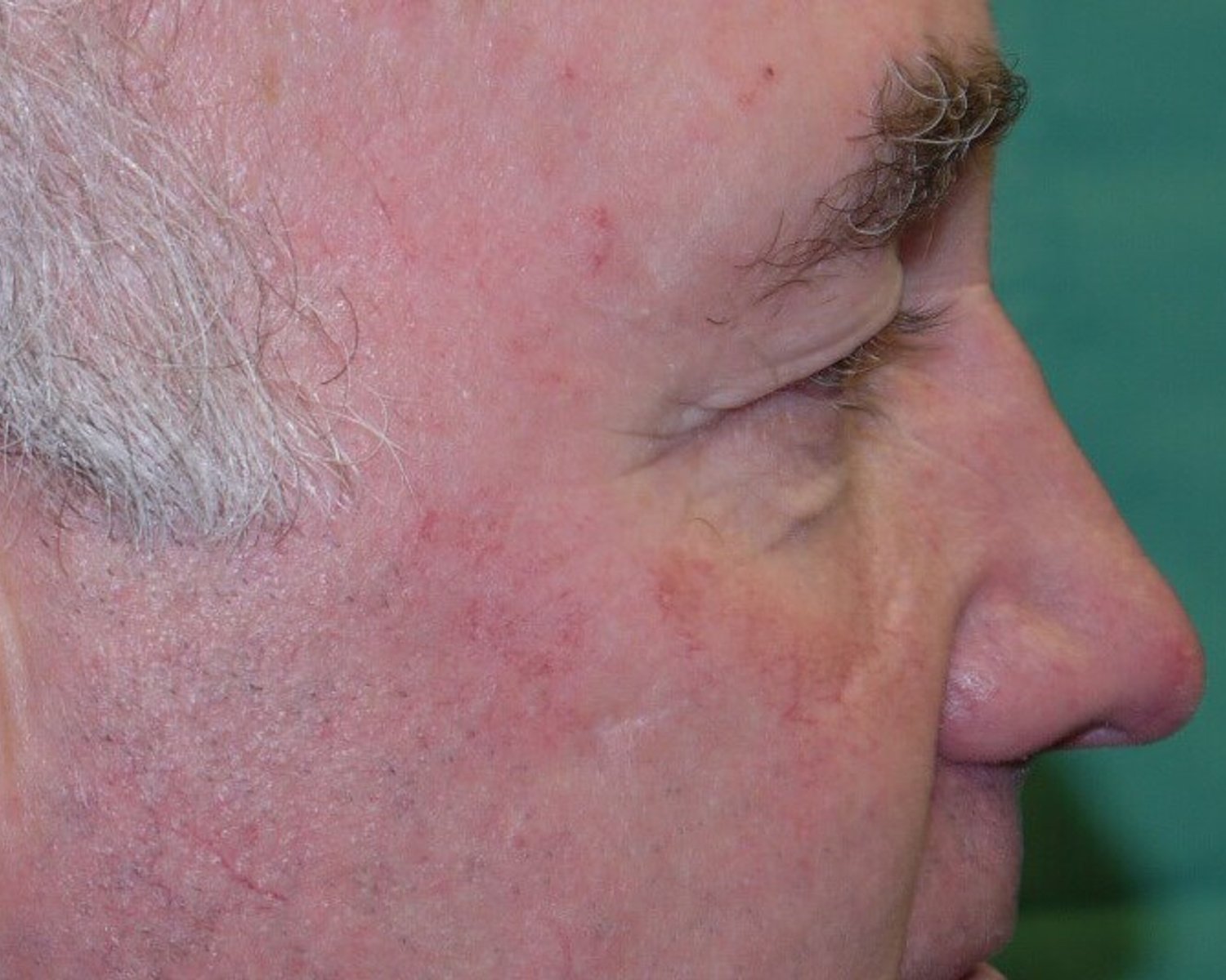 Eyelid Surgery — Oblique Right view, before