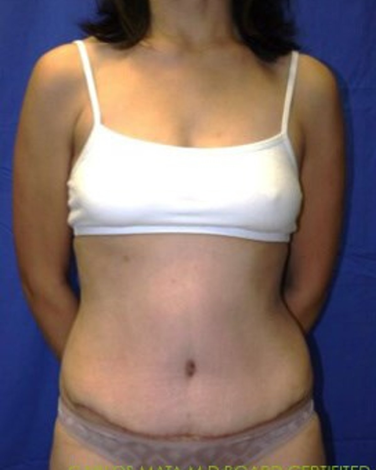 Tummy Tuck after