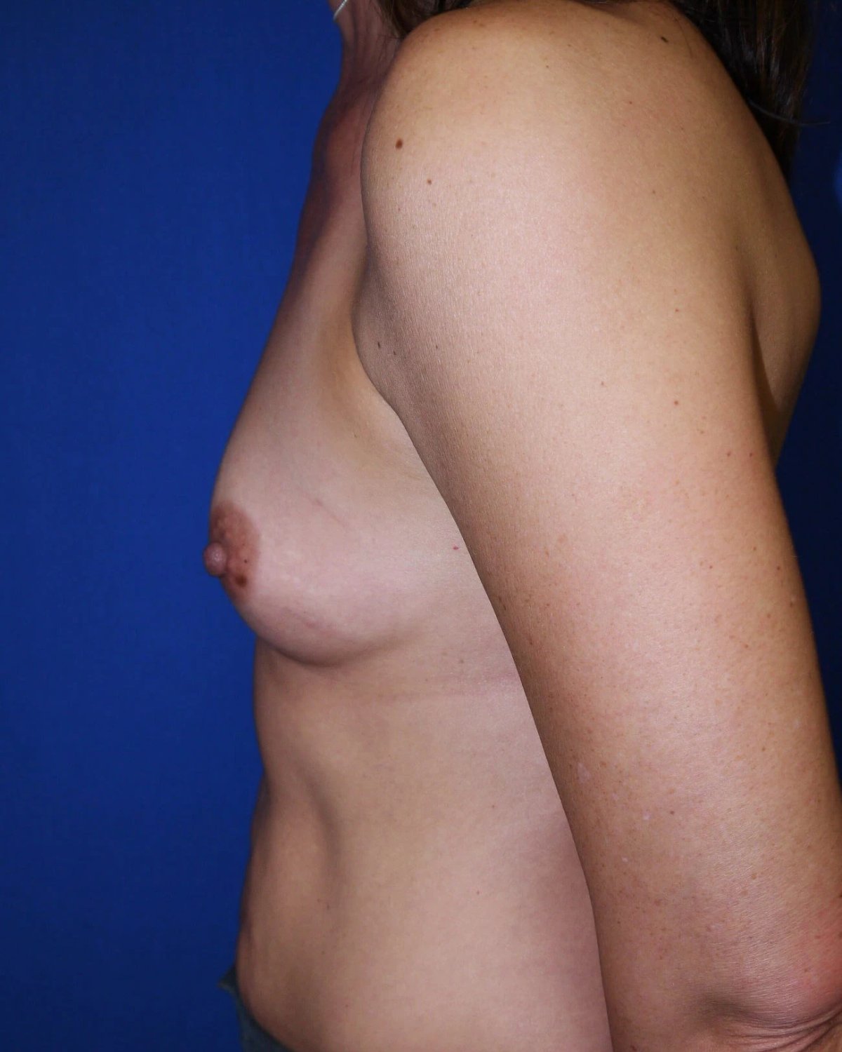 Breast Augmentation with Implants — Left Profile view, before