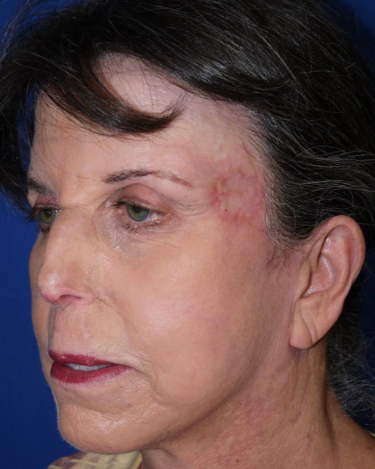 Facelift (neck lift included) after