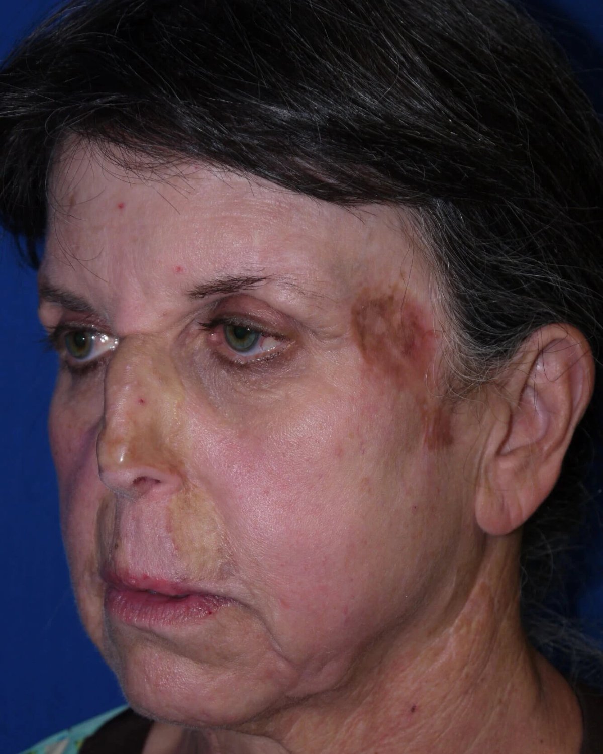 Facelift (neck lift included) before