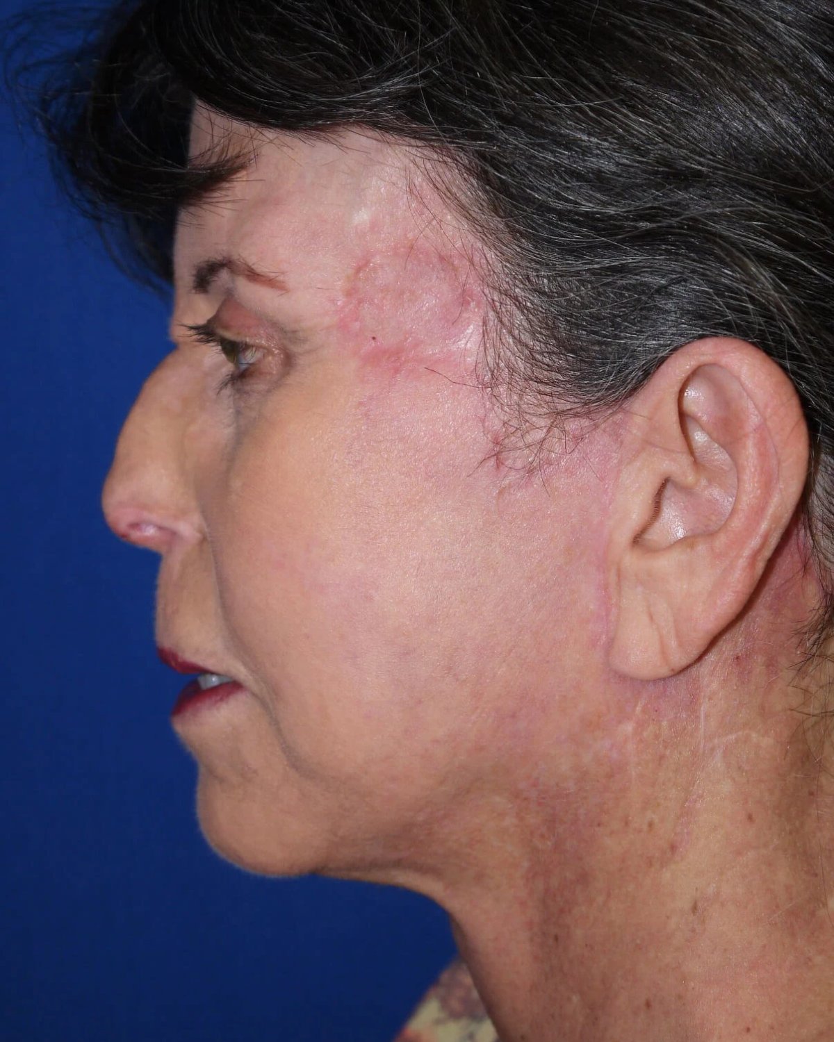 Facelift (neck lift included) — Left Profile view, after