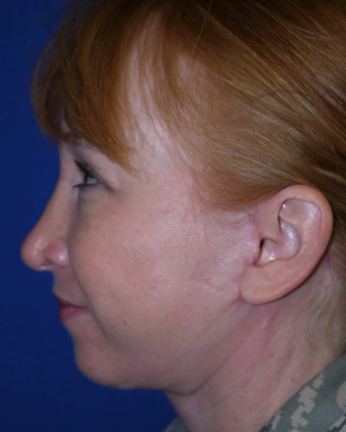 Facelift (neck lift included) — Oblique Left view, after