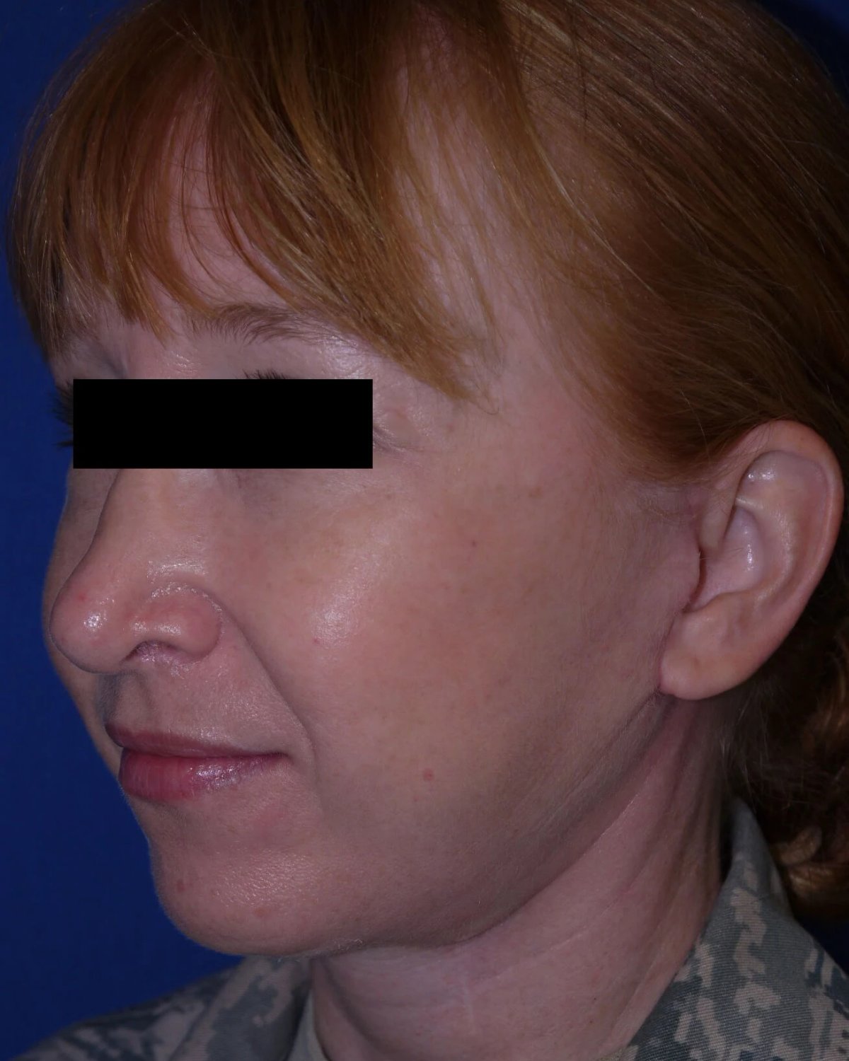 Facelift (neck lift included) — Oblique Right view, after