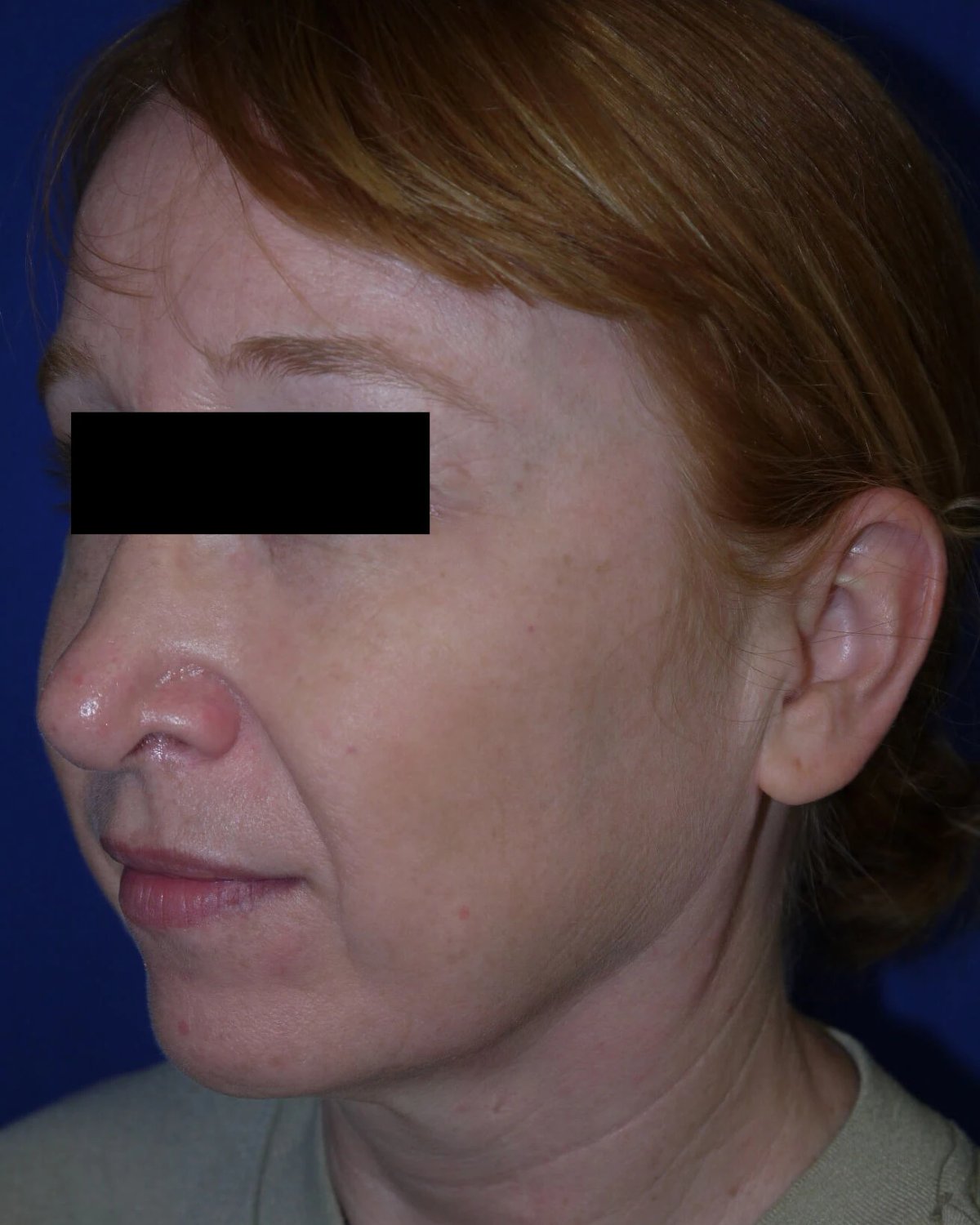 Facelift (neck lift included) — Oblique Right view, before