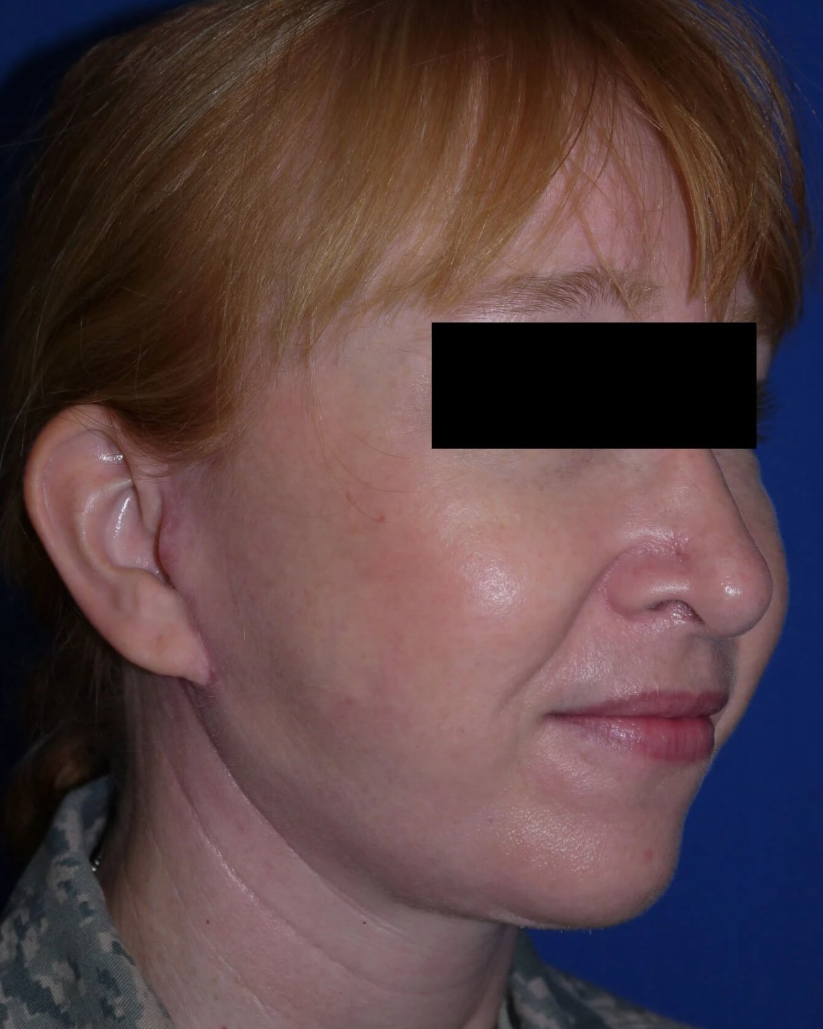 Facelift (neck lift included) after