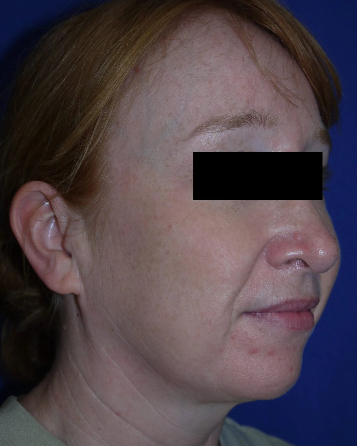 Facelift (neck lift included) before