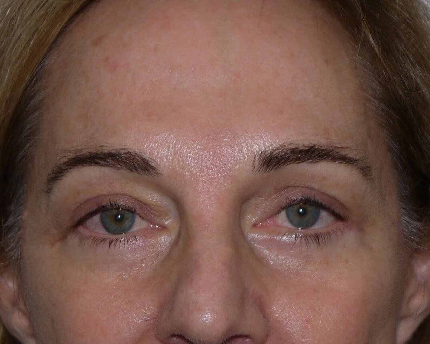 Eyelid Surgery after
