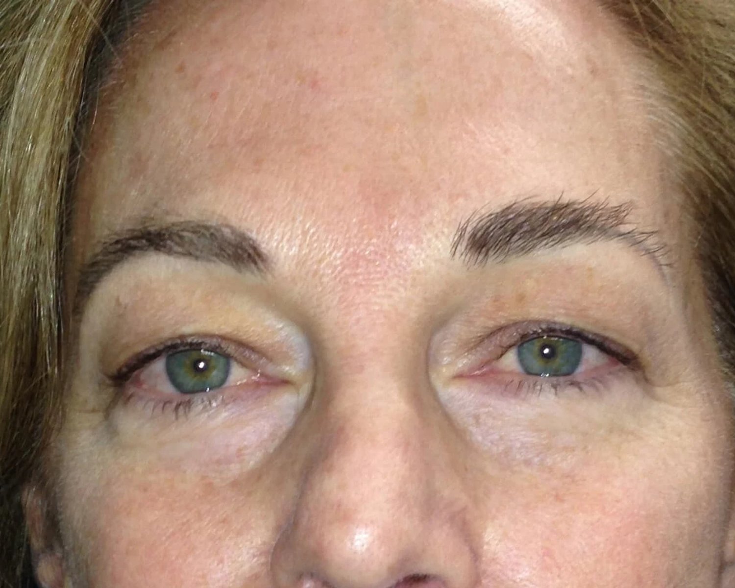 Eyelid Surgery before