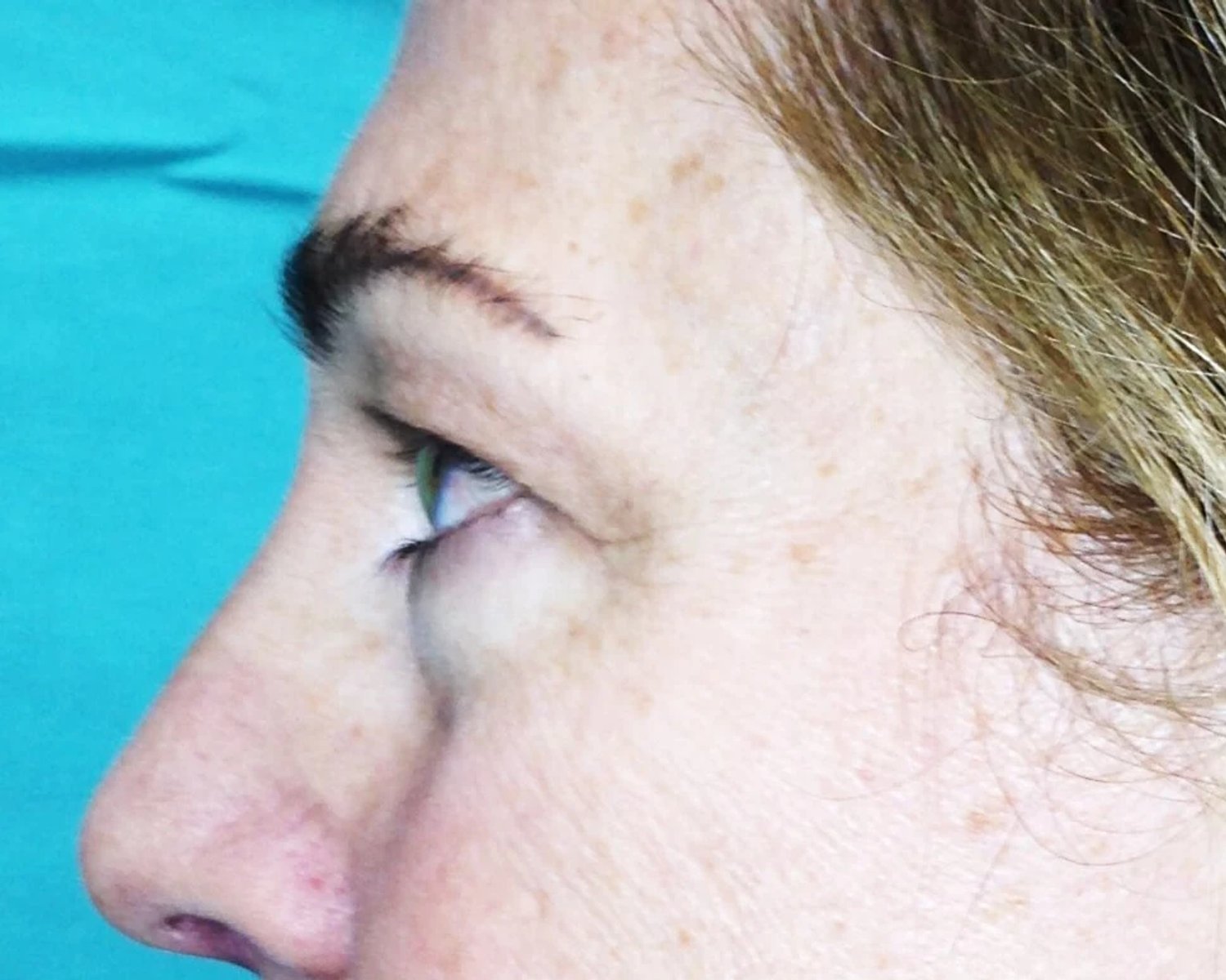 Eyelid Surgery — Oblique Left view, before
