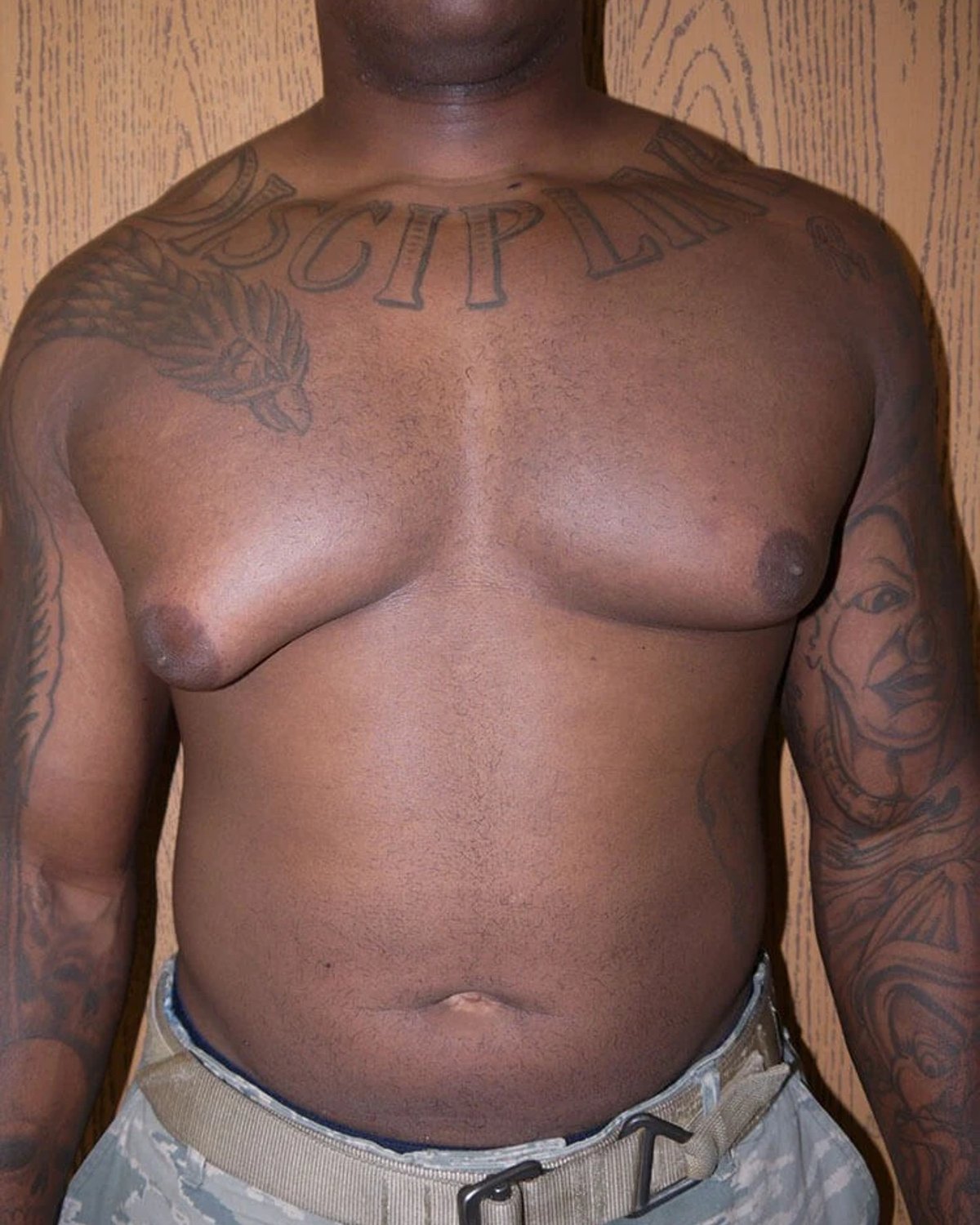 One-Stitch Gynecomastia before