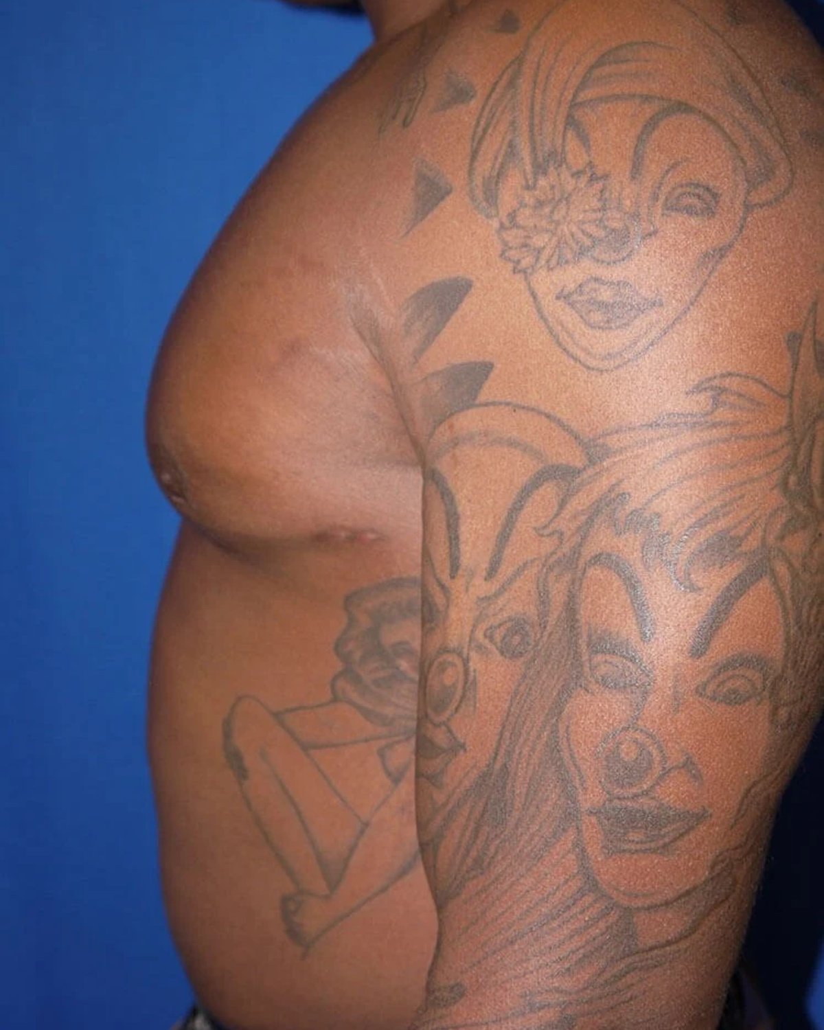 One-Stitch Gynecomastia — Oblique Left view, after