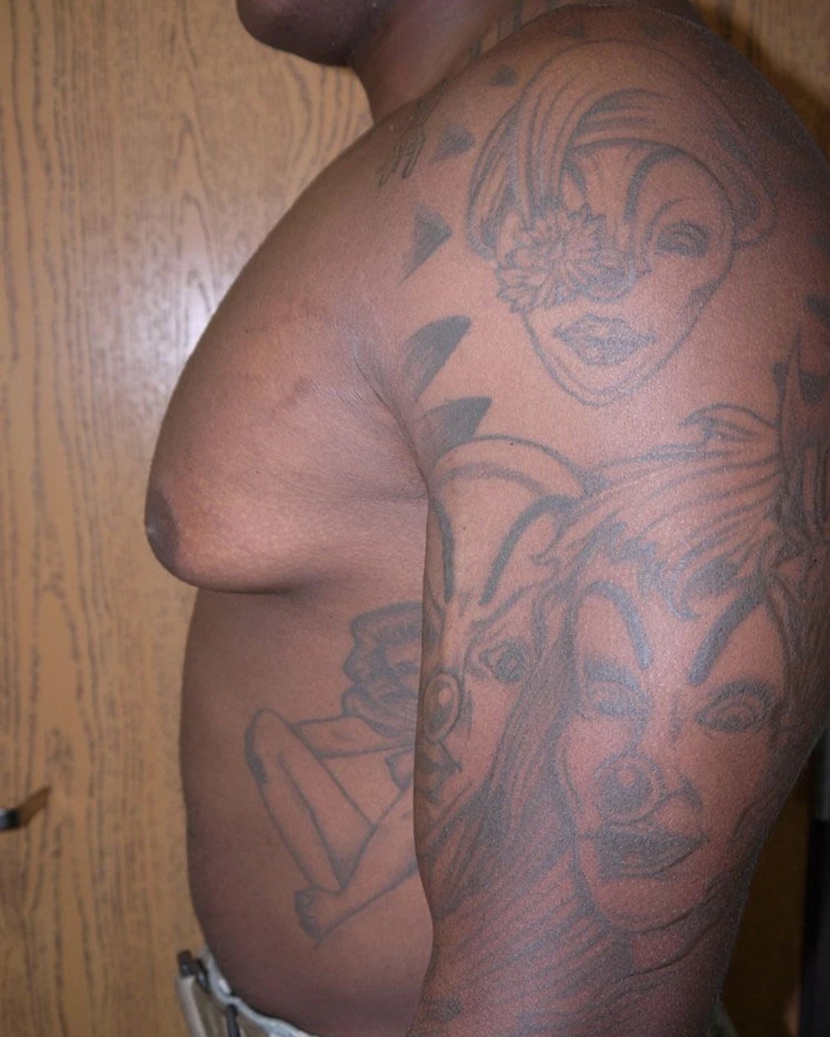 One-Stitch Gynecomastia — Oblique Left view, before