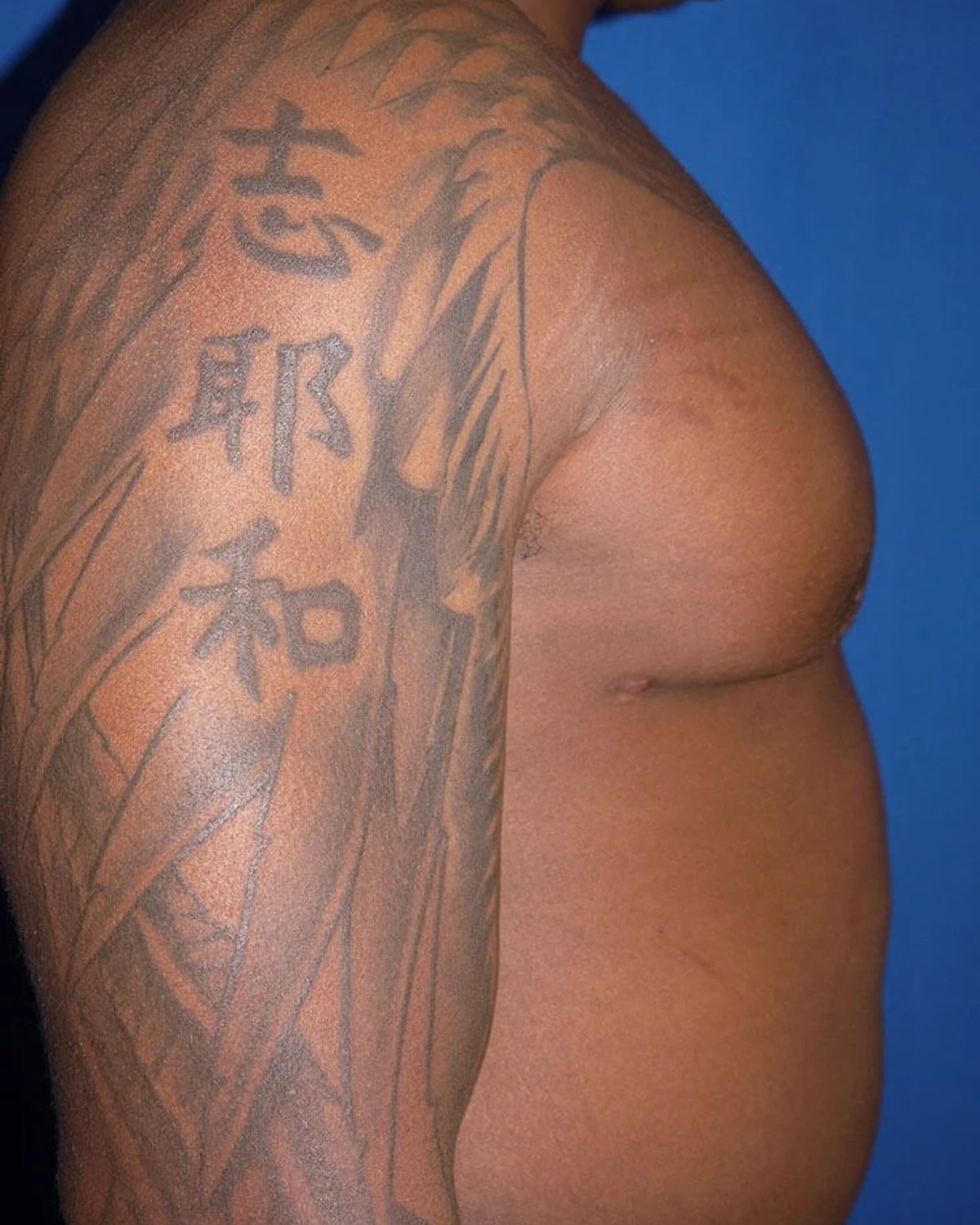 One-Stitch Gynecomastia — Oblique Right view, after