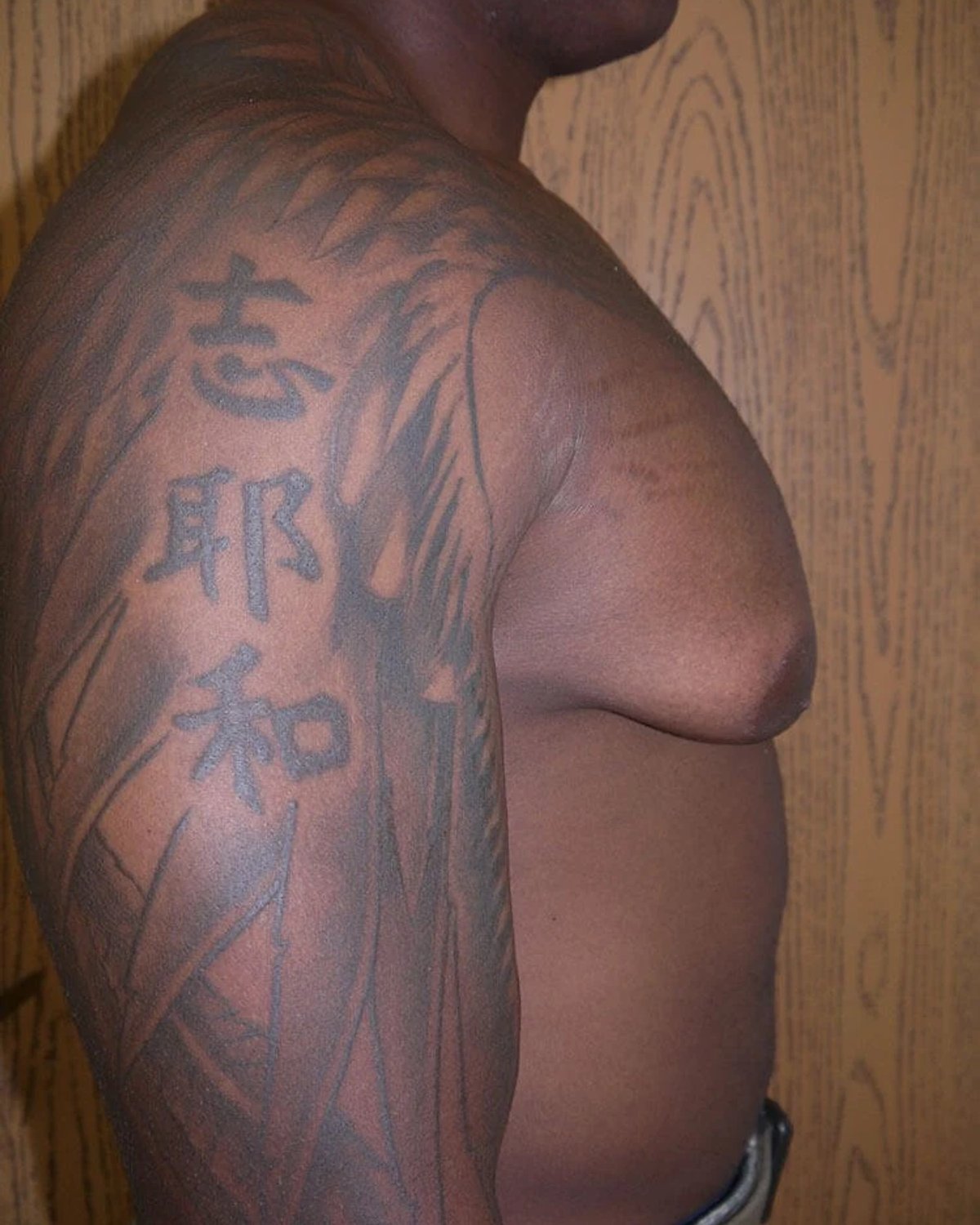 One-Stitch Gynecomastia — Oblique Right view, before