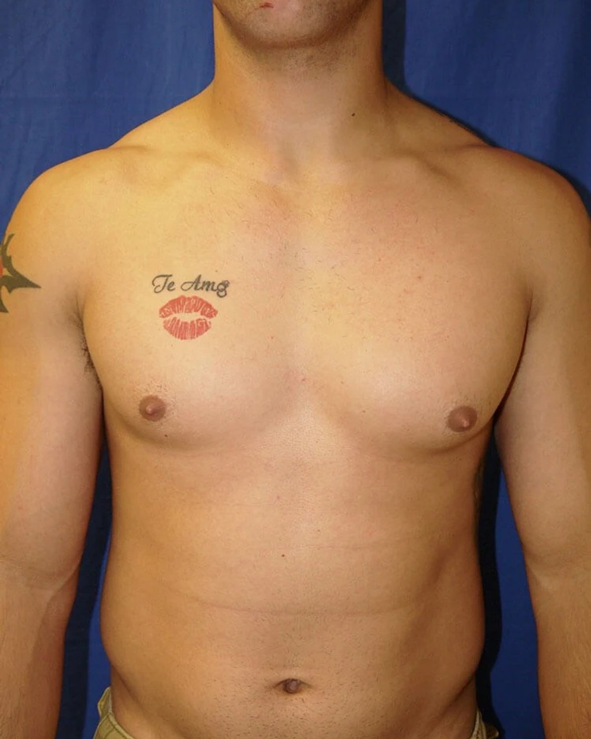One-Stitch Gynecomastia before
