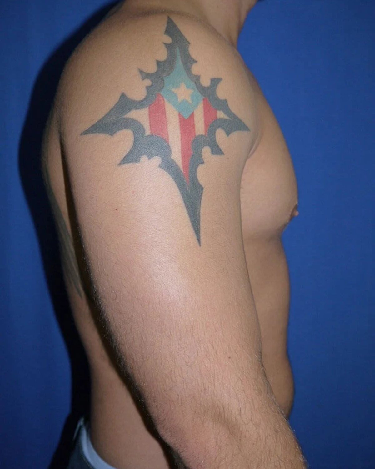 One-Stitch Gynecomastia — Oblique Right view, after