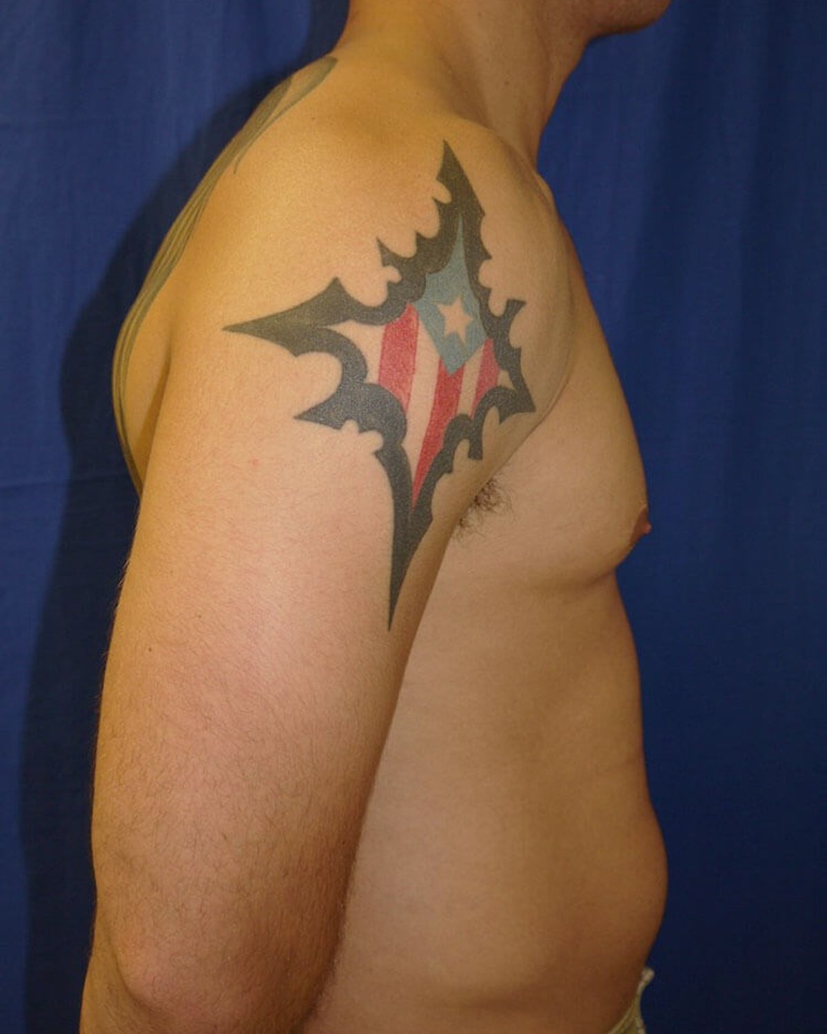 One-Stitch Gynecomastia — Oblique Right view, before