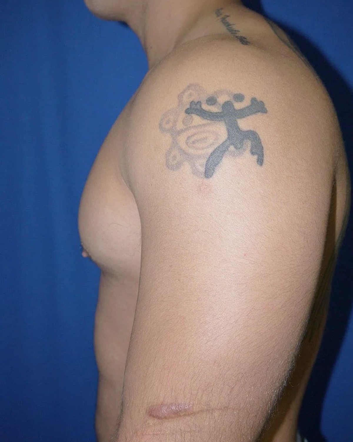 One-Stitch Gynecomastia — Right Profile view, after