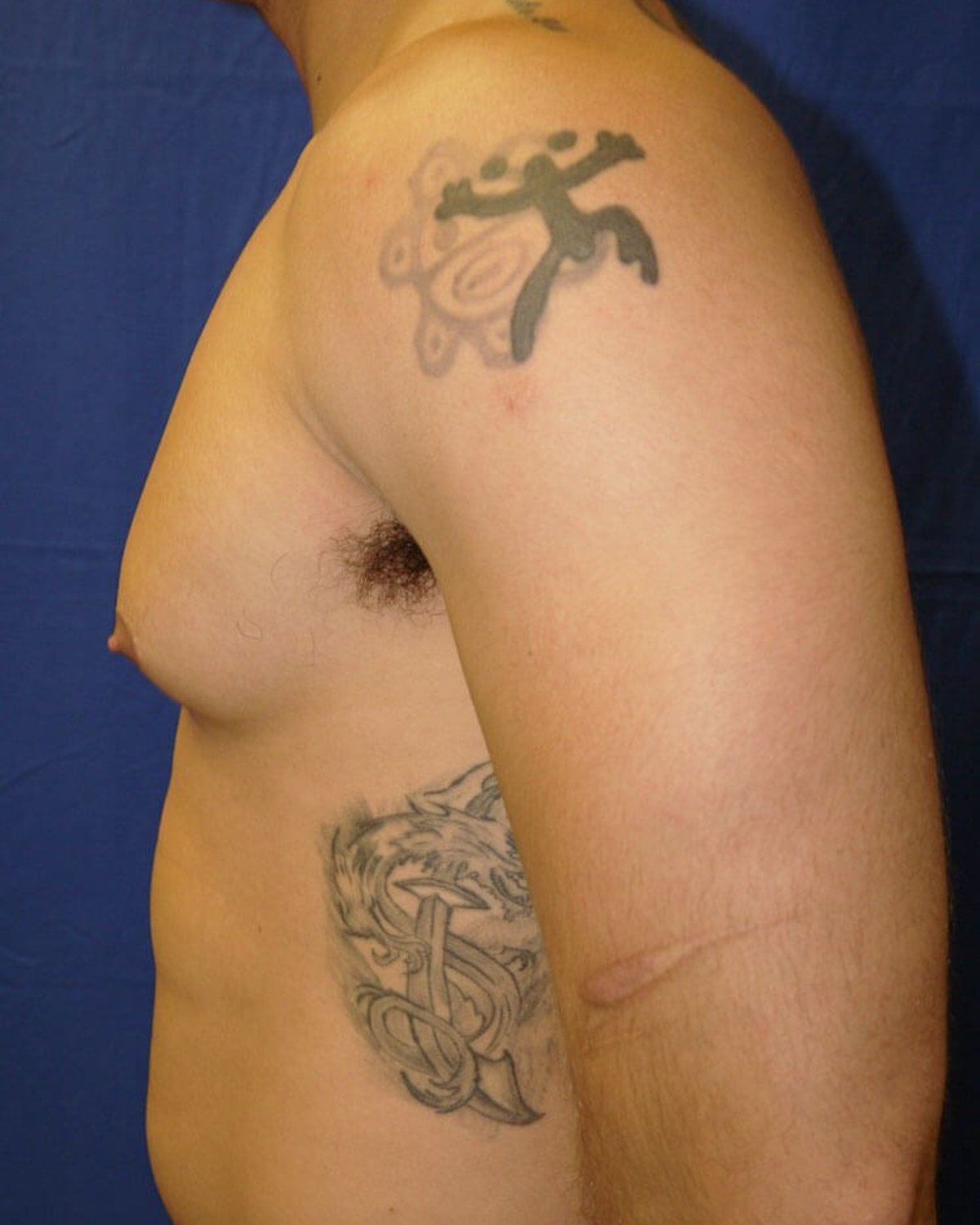 One-Stitch Gynecomastia — Right Profile view, before