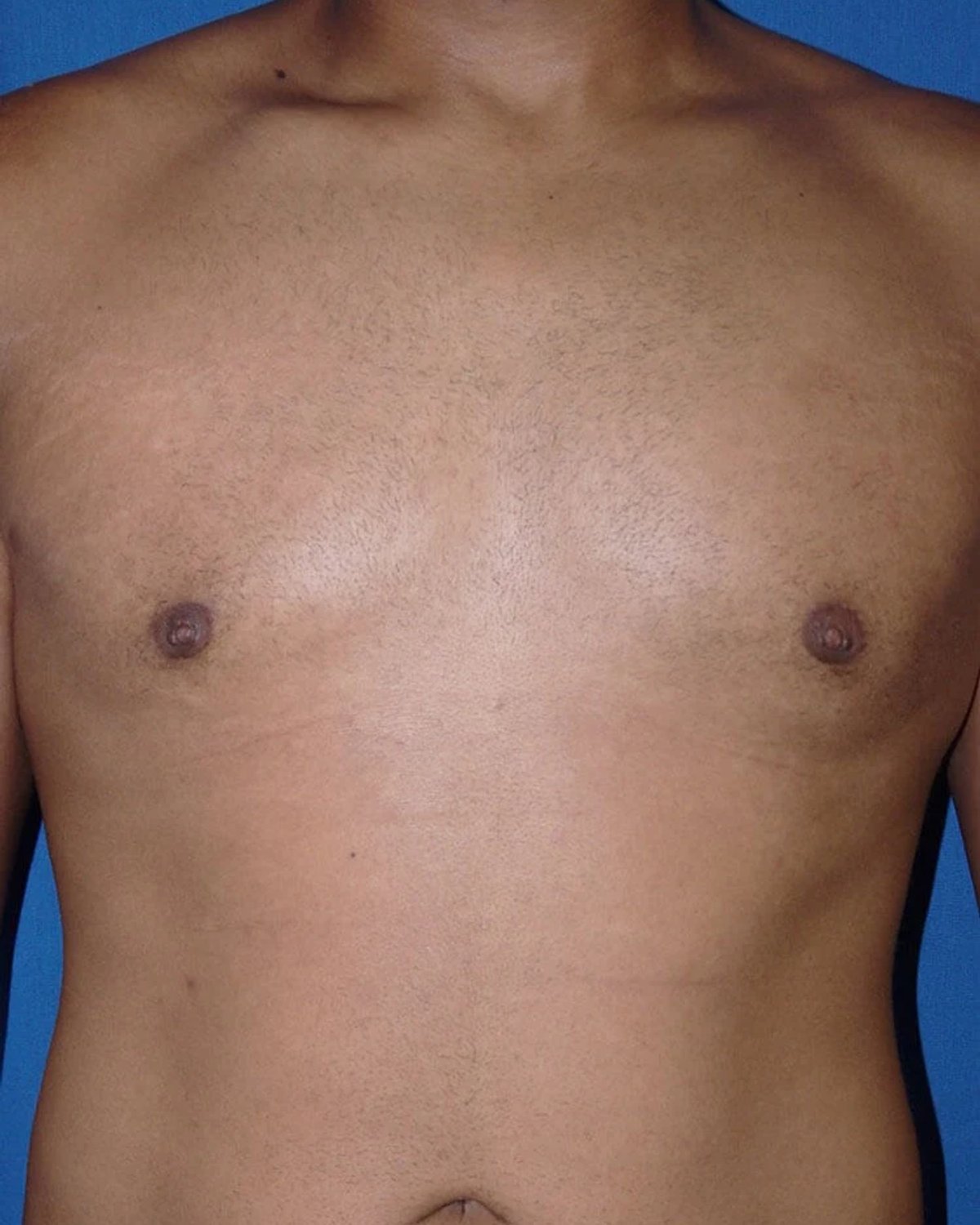One-Stitch Gynecomastia after