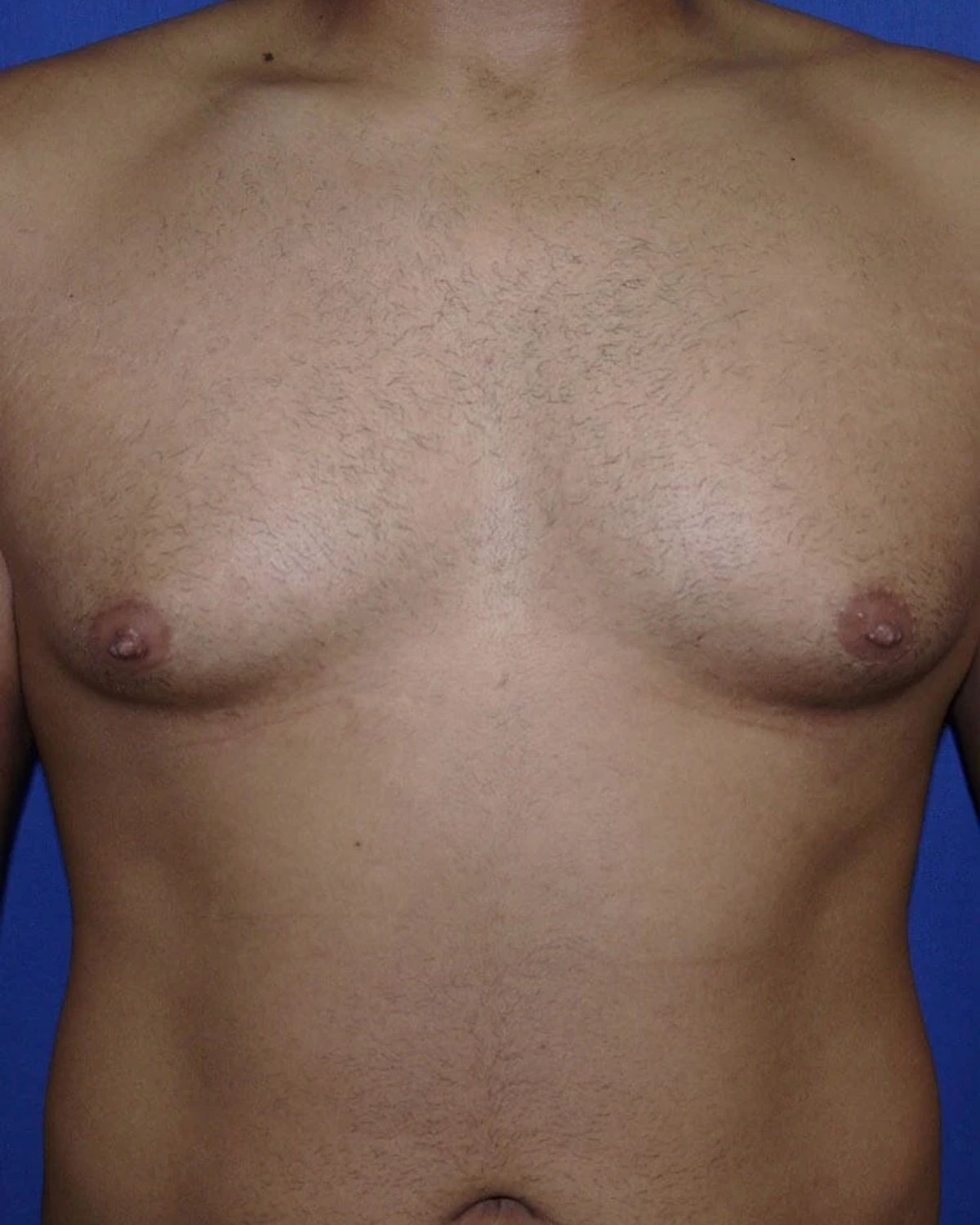 One-Stitch Gynecomastia before