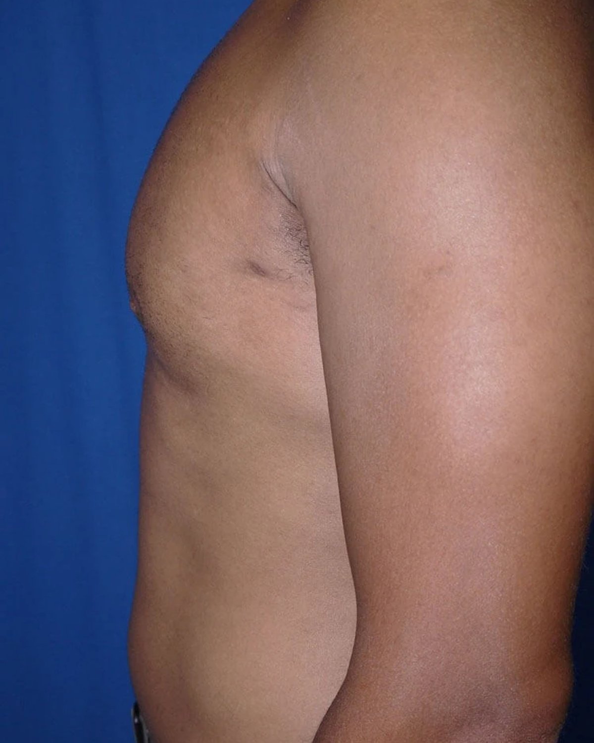 One-Stitch Gynecomastia — Left Profile view, after