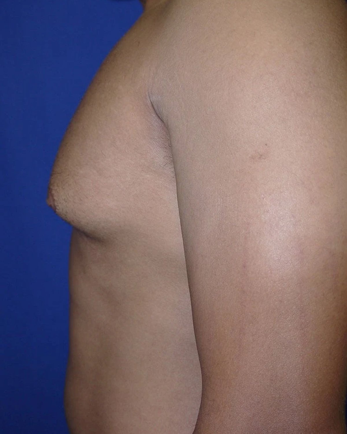 One-Stitch Gynecomastia — Left Profile view, before