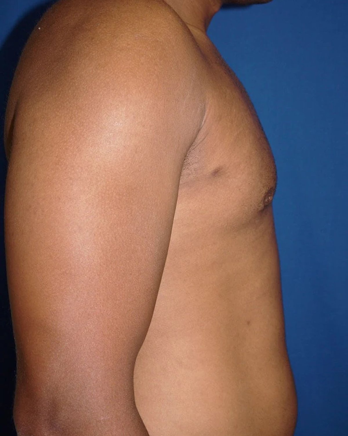 One-Stitch Gynecomastia — Right Profile view, after