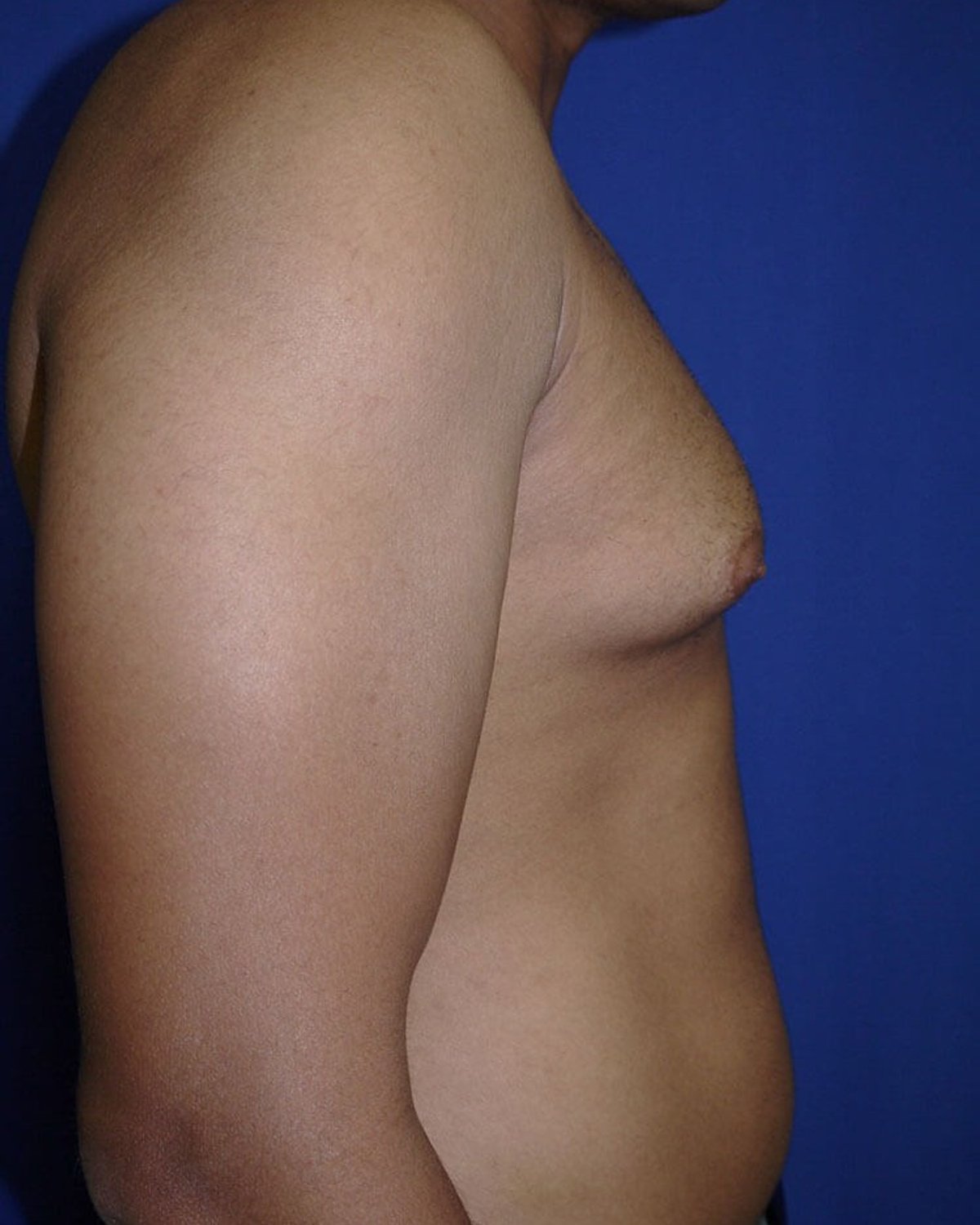 One-Stitch Gynecomastia — Right Profile view, before