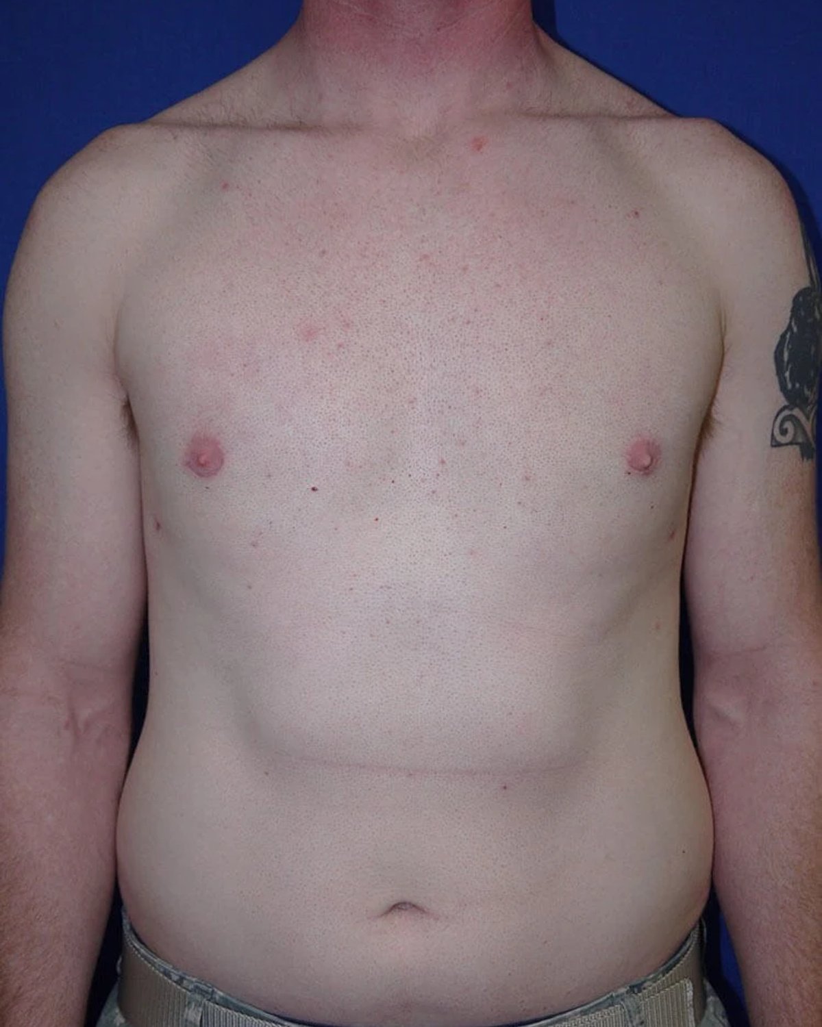 One-Stitch Gynecomastia after