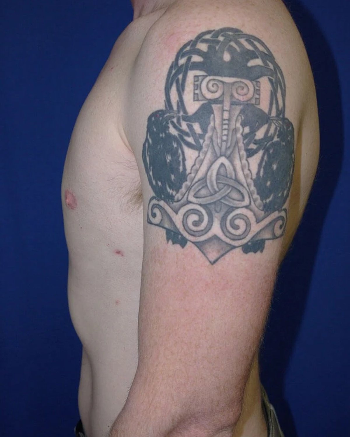 One-Stitch Gynecomastia — Left Profile view, after