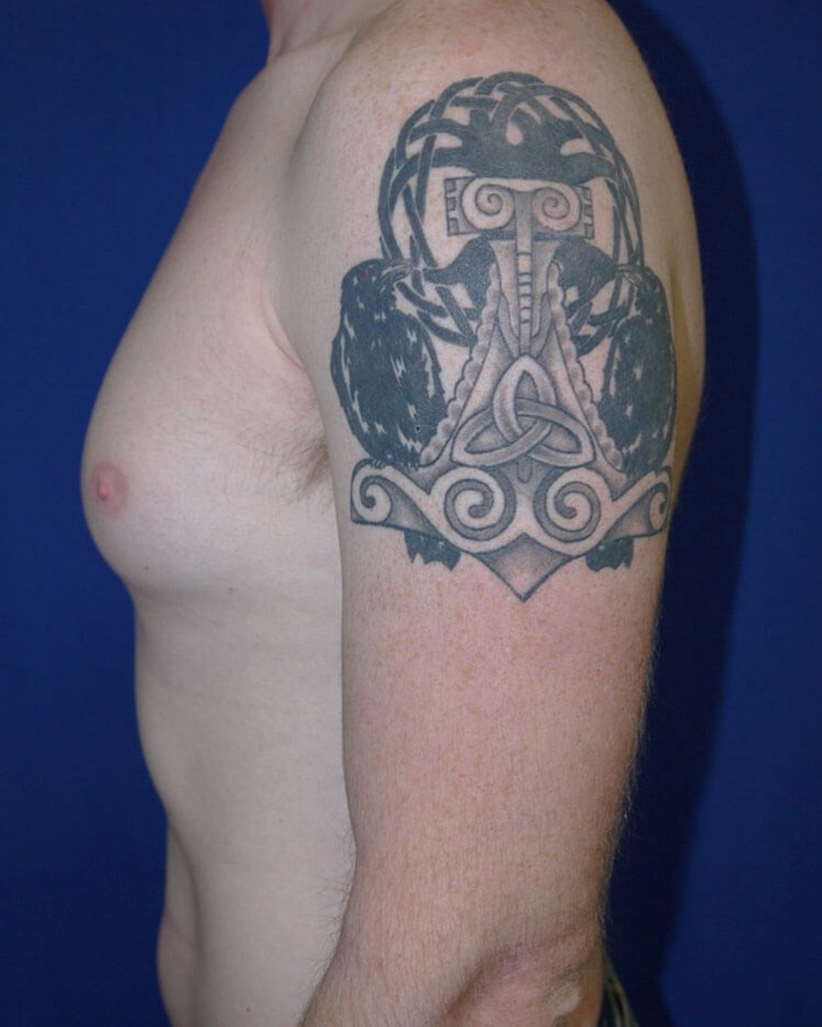 One-Stitch Gynecomastia — Left Profile view, before
