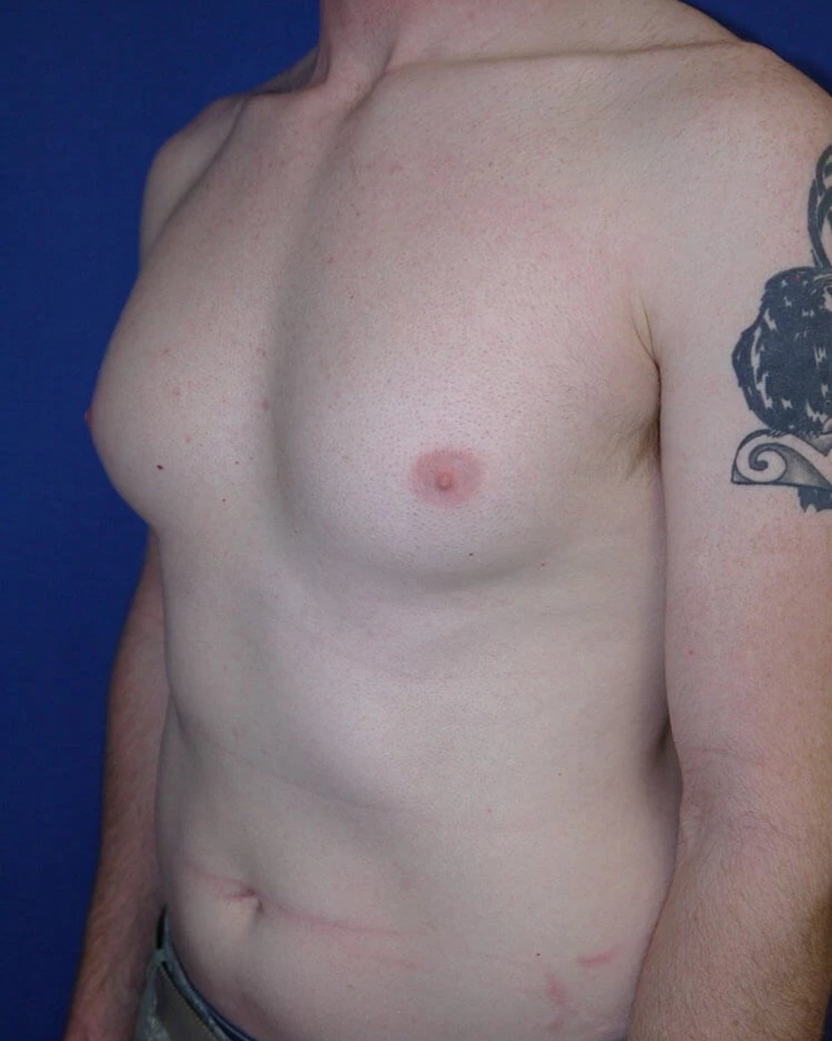 One-Stitch Gynecomastia — Oblique Right view, before