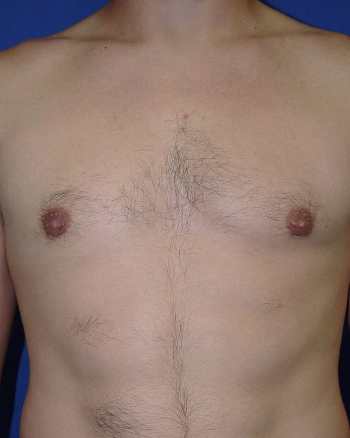 One-Stitch Gynecomastia after