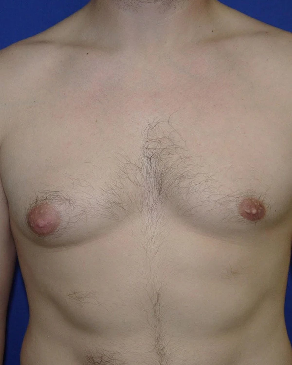 One-Stitch Gynecomastia before