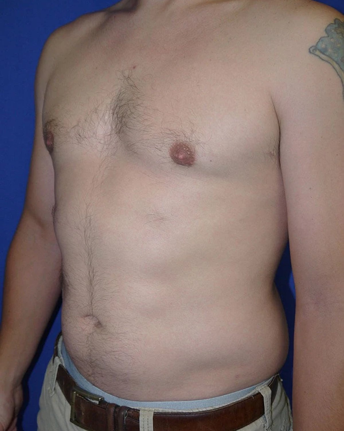 One-Stitch Gynecomastia — Oblique Right view, after