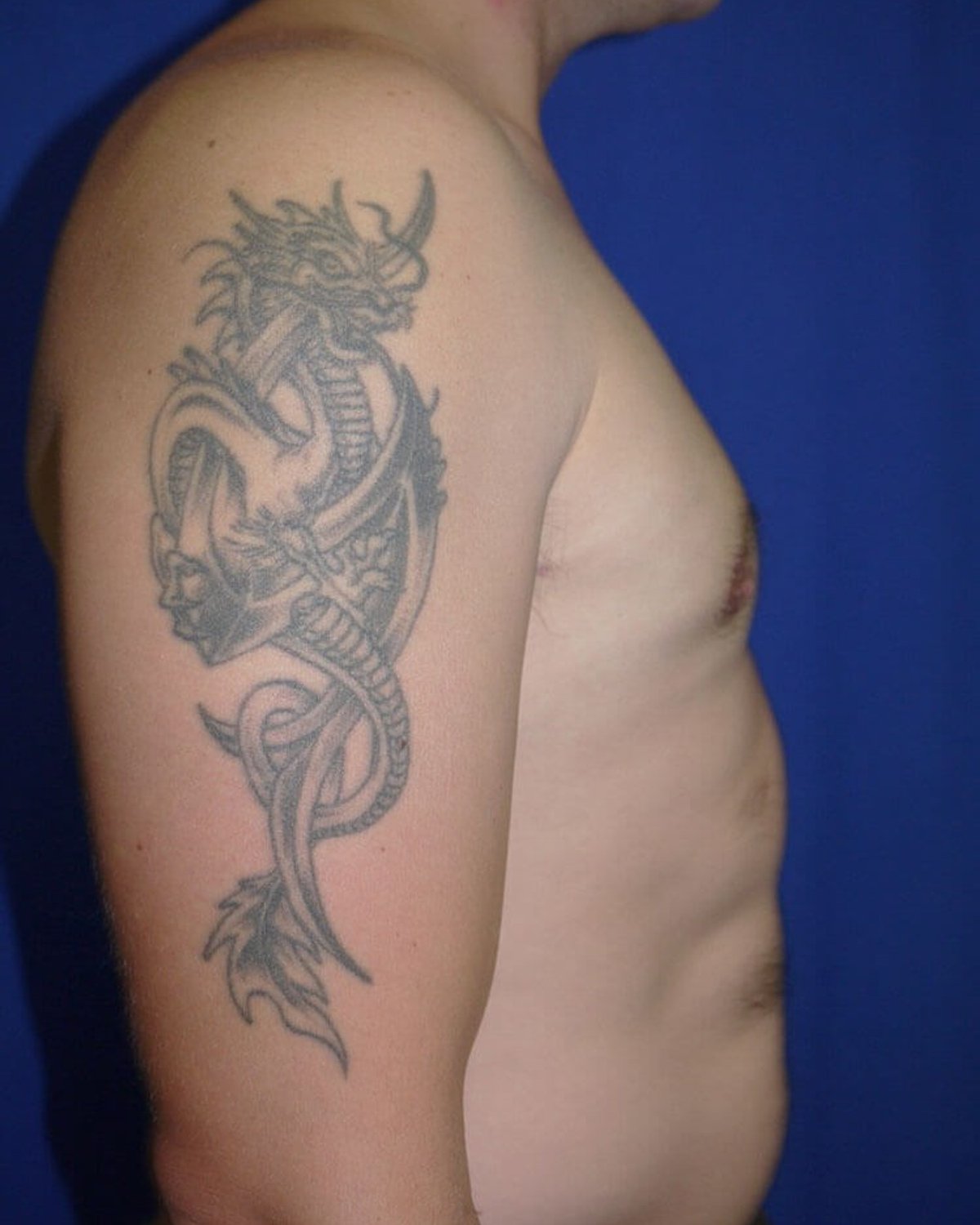 One-Stitch Gynecomastia — Right Profile view, after
