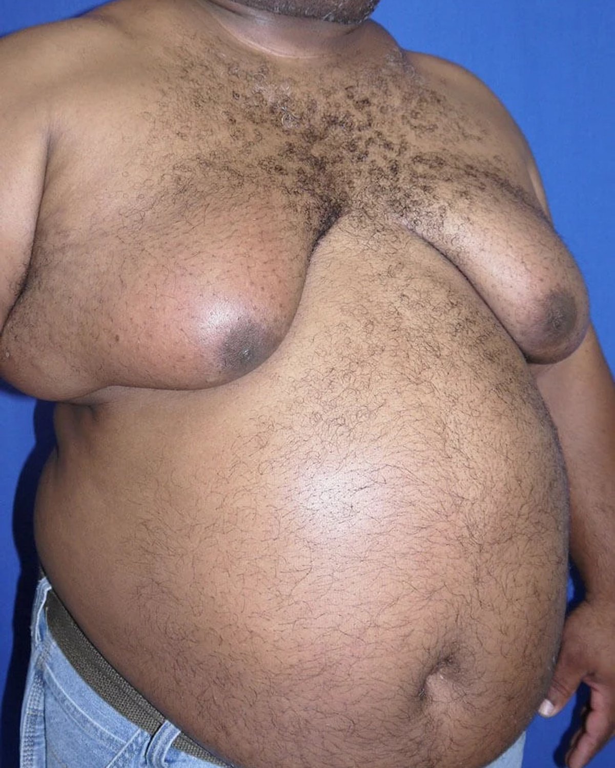 One-Stitch Gynecomastia — Oblique Right view, before