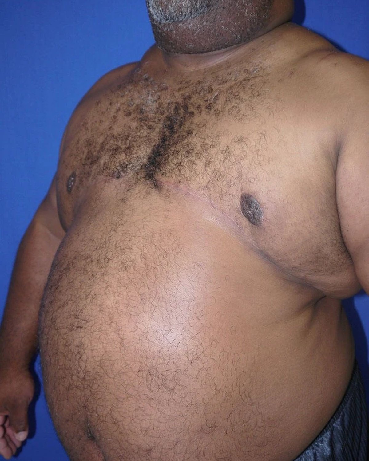 One-Stitch Gynecomastia after